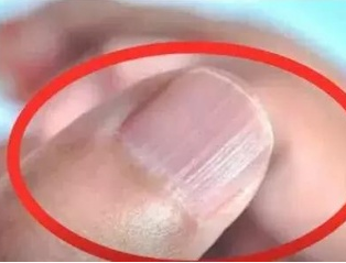香蕉视频污污下载厂家分析手指甲有竖纹的根本原因 香蕉视频污污下载厂家分析手指甲有竖纹的根本原因